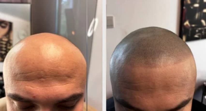 Scalp micropigmentation resultat - före efter collage Stockholm