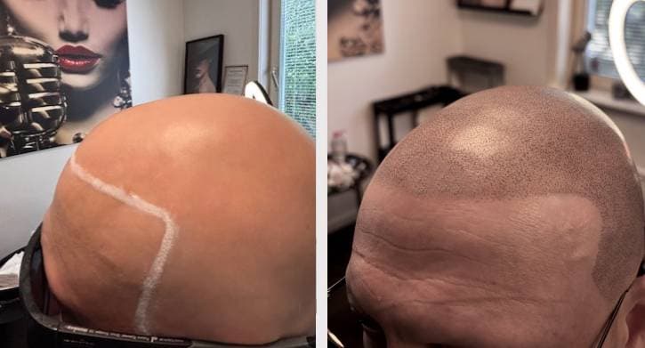 SMP behandling - naturligt resultat hårlinje