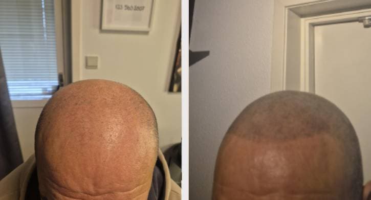 Skalp mikropigmentering - skarpare hårlinje man