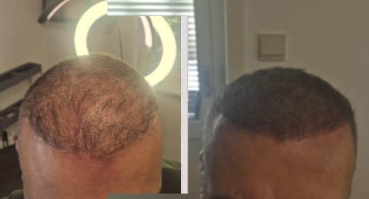 SMP före efter - Alan resultat Stockholm