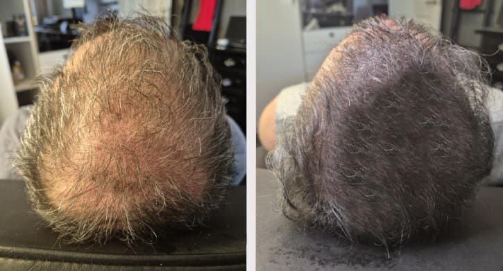 Hårpigmentering fylligare look - SMP resultat