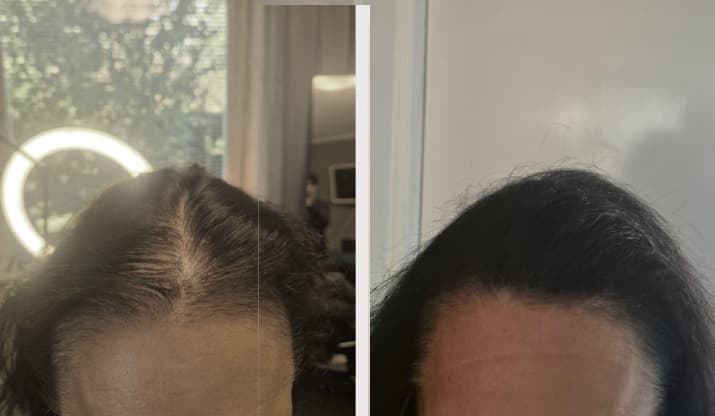 SMP resultat - Anita, Ärrkamouflering