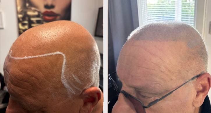 Skalp mikropigmentering collage - före efter jämförelse