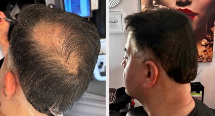 SMP behandling - Hamid resultat