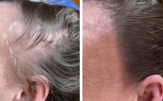 Hårtäthet kvinna - Linnea före efter