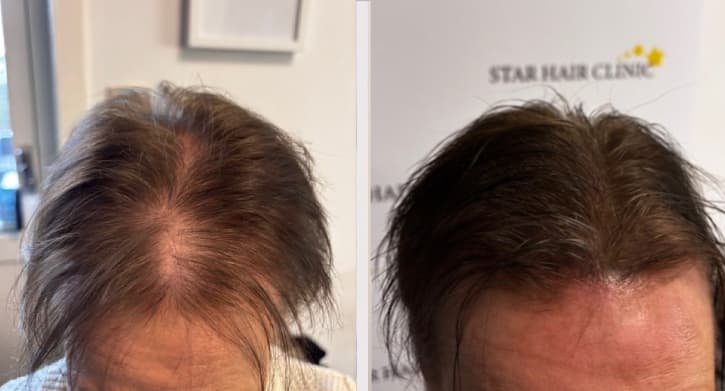 SMP resultat - Malin, Hårtäthet (Density)