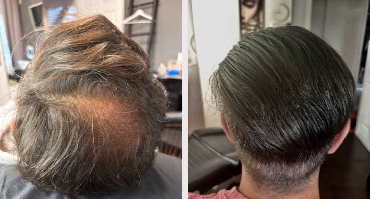Scalp micropigmentation - Oscar resultat