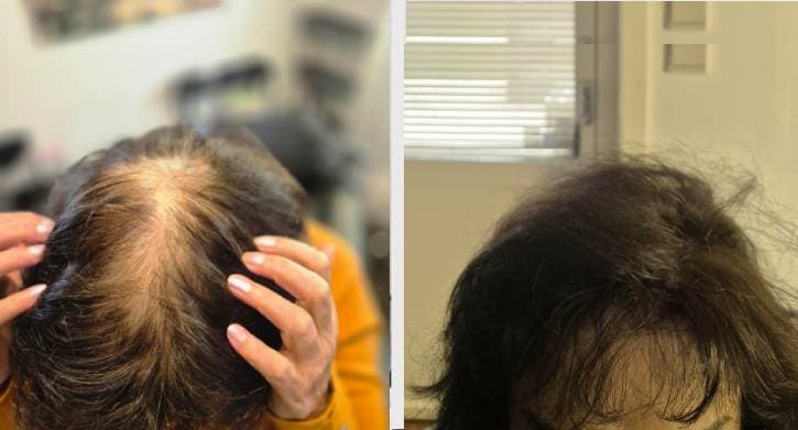 Hårtäthet behandling - Sanam resultat