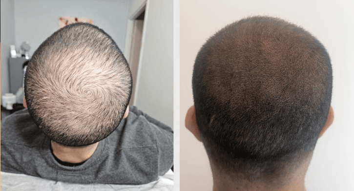 SMP resultat - Simon, Komplett SMP