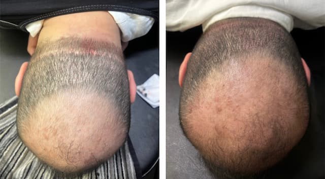 Skalp mikropigmentering ovanifrån - före efter resultat