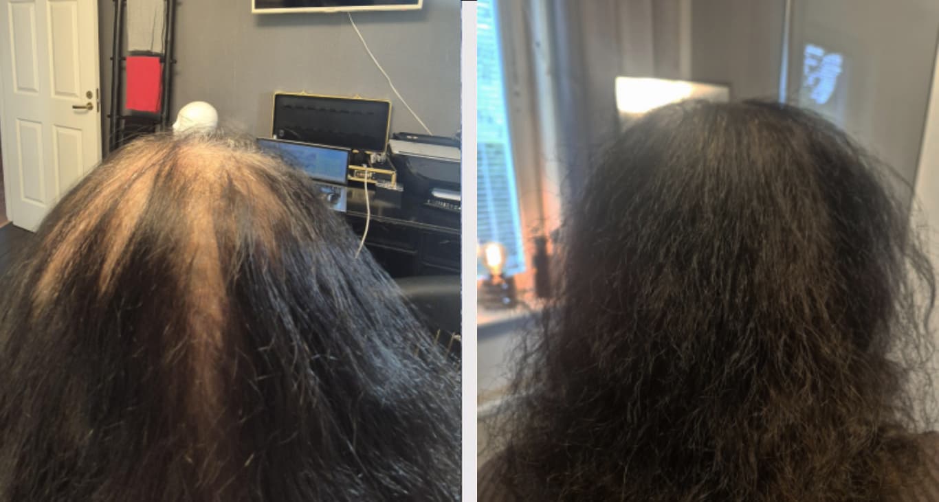 SMP densitet kvinna - Sofia detaljerad