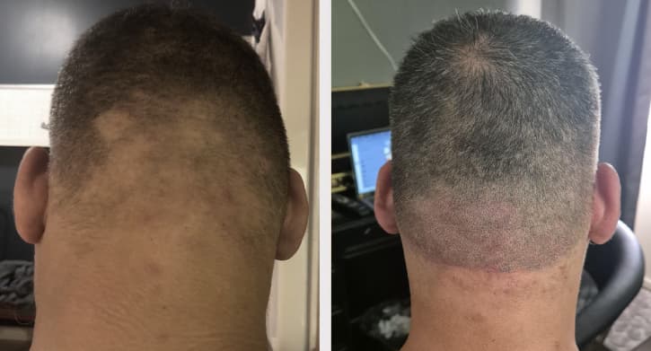 Scalp micropigmentation - Ziad collage resultat