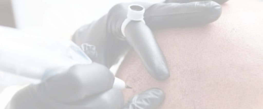 Star Hair Clinic nöjdhetsgaranti - professionell SMP behandling Stockholm